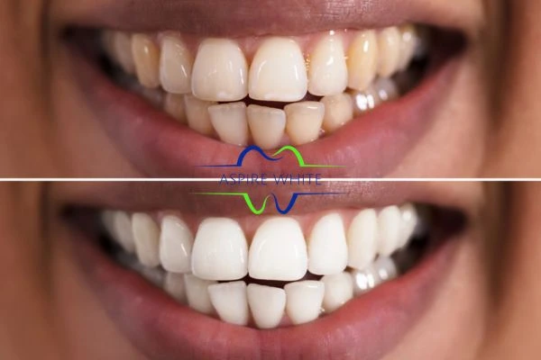 Aspire White customer before and after Towcester results.