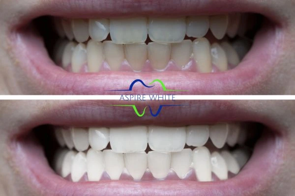 1 hour laser teeth whitening before and after results Towcester
