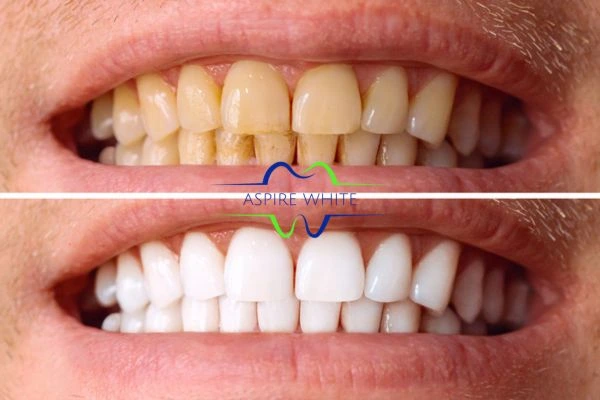 Get noticeable whiter smile in just one hour! Book your teeth whitening treatment Towcester today!
