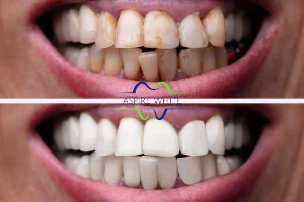 Before and after results of laser teeth whitening Towcester Book in online today!
