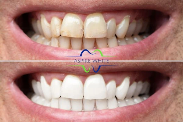 Achieve a radiant smile with professional laser teeth whitening Towcester
